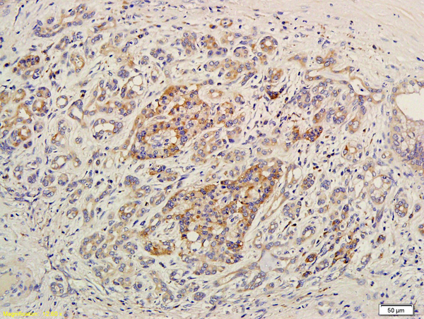 Formalin-fixed and paraffin embedded human pancreatic cancer labeled with Anti-EDG7/LPA3 Polyclonal Antibody, Unconjugated (bs-2882R) at 1:400 followed by conjugation to the secondary antibody and DAB staining