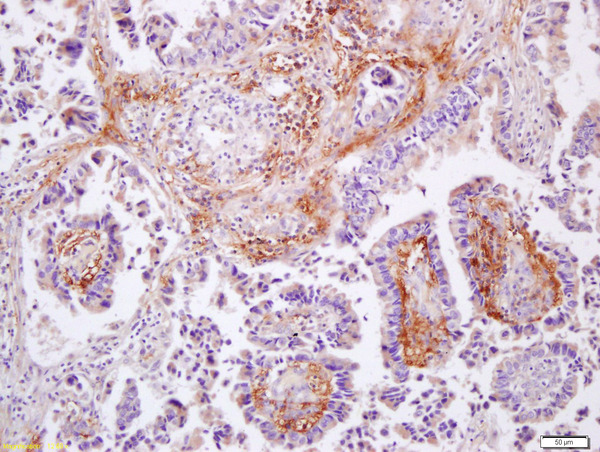 Formalin-fixed and paraffin embedded human lung caricoma labeled with Anti-MMP-9  Polyclonal Antibody, Unconjugated (bs-0397R) at 1:200 followed by conjugation to the secondary antibody and DAB staining