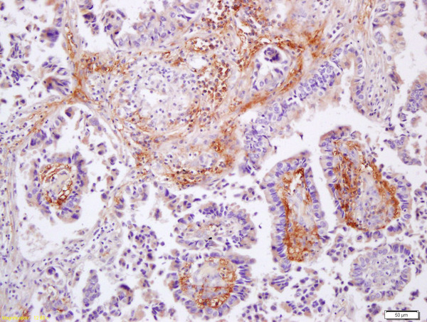 Formalin-fixed and paraffin embedded human lung caricoma labeled with Anti-MMP-9 Polyclonal Antibody, Unconjugated (bs-0397R) at 1:200 followed by conjugation to the secondary antibody and DAB staining