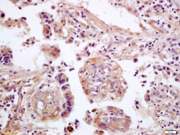 Formalin-fixed and paraffin embedded human lung carcinoma labeled with Anti-WNT5A Polyclonal Antibody, Unconjugated (bs-1948R) at 1:200 followed by conjugation to the secondary antibody and DAB staining