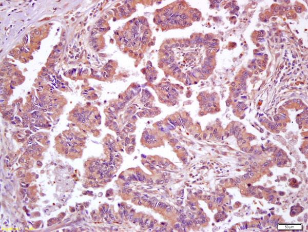 Formalin-fixed and paraffin embedded human lung carcinoma labeled with Anti-HSF1 Polyclonal Antibody, Unconjugated (bs-3757R) at 1:200 followed by conjugation to the secondary antibody and DAB staining