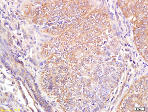 Formalin-fixed and paraffin embedded human breast carcinoma labeled with Anti Wnt6 Polyclonal Antibody, Unconjugated (bs-6135R) at 1:200 followed by conjugation to the secondary antibody and DAB staining