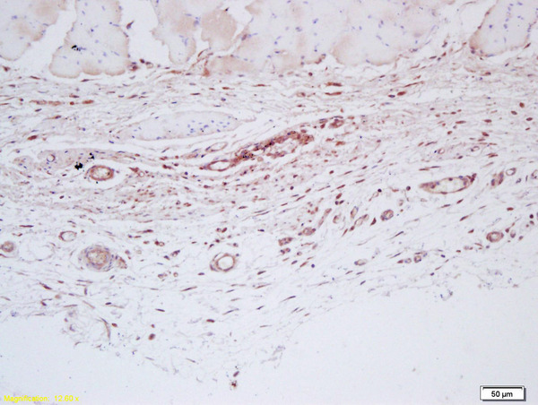 Formalin-fixed and paraffin embedded human skin labeled with Anti-Factor VIII Polyclonal Antibody, Unconjugated (bs-2974R) at 1:200 followed by conjugation to the secondary antibody and DAB staining
