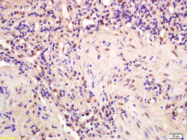 Formalin-fixed and paraffin embedded human gastric carcinoma labeled with Anti-CPSF4/CPSF30 Polyclonal Antibody, Unconjugated (bs-2253R) at 1:200 followed by conjugation to the secondary antibody and DAB staining