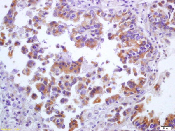 Formalin-fixed and paraffin embedded human lung carcinoma labeled with Anti-5 lipoxygenase\/ALOX5 Polyclonal Antibody, Unconjugated (bs-0526R) at 1:200 followed by conjugation to the secondary antibody and DAB staining