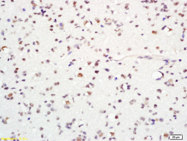 Formalin-fixed and paraffin embedded human glioma labeled with ASCL1 Polyclonal Antibody, Unconjugated (bs-1155R) at 1:200 followed by conjugation to the secondary antibody and DAB staining