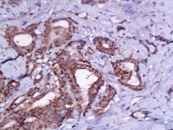 Formalin-fixed and paraffin embedded human lung tissue labeled with Rabbit Anti-TSHR Polyclonal Antibody (bs-0206R) at 1:200 followed by conjugation to the secondary antibody and DAB staining.