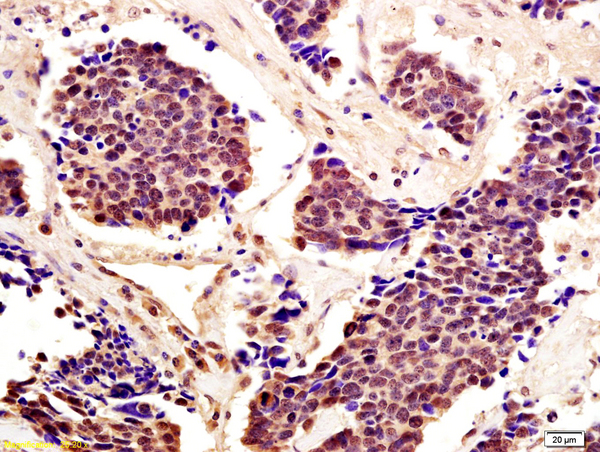 Formalin-fixed and paraffin embedded human lung carcinoma with labeled Anti-Cytomegalovirus pp65 Polyclonal Antibody, Unconjugated (bs-0271R) at 1:200, followed by conjugation to the secondary antibody and DAB staining Formalin-fixed and paraffin embedded human lung carcinoma with labeled Anti-Cytomegalovirus pp65 Polyclonal Antibody, Unconjugated (bs-0271R) at 1:200, followed by conjugation to the secondary antibody and DAB staining