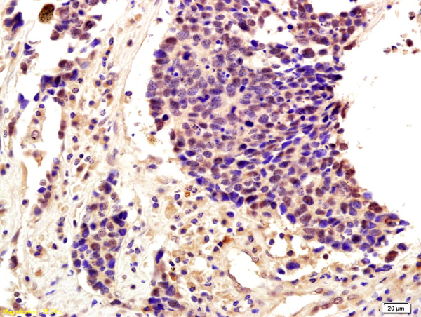 Formalin-fixed and paraffin embedded human lung cancer labeled with Anti-SNAI2/SLUG Polyclonal Antibody, Unconjugated (bs-1382R) followed by conjugation to the secondary antibody and DAB staining