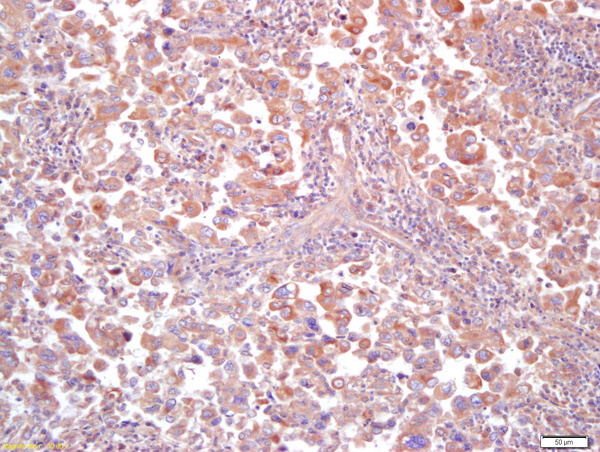 Formalin-fixed and paraffin embedded human lung carcinoma labeled with Anti MT-ND5Polyclonal Antibody (bs-3952R), Unconjugated at 1:200, followed by conjugation to the secondary antibody and DAB staining
