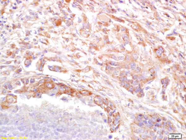 Formalin-fixed and paraffin embedded human lung carcinoma labeled with Anti PRSS8 Polyclonal Antibody (bs-6064R), Unconjugated at 1:200, followed by conjugation to the secondary antibody and DAB staining