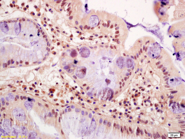Formalin-fixed and paraffin embedded human gastric cancer labeled with Anti-FZR1/CDC20C Polyclonal Antibody, Unconjugated (bs-13240R) at 1:200 followed by conjugation to the secondary antibody and DAB staining
