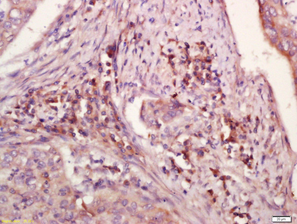 Formalin-fixed and paraffin embedded human laryngocarcinoma labeled with Anti-WDR26 Polyclonal Antibody, Unconjugated (bs-0932R) at 1:200 followed by conjugation to the secondary antibody and DAB staining