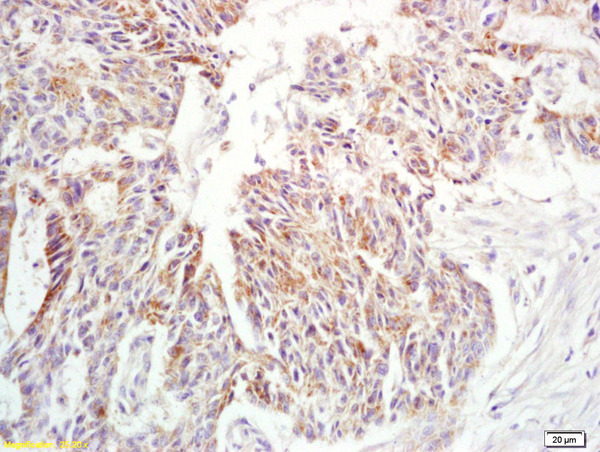 Formalin-fixed and paraffin embedded human rectal carcinoma labeled with Anti-IL-6 Polyclonal Antibody, Unconjugated (bs-4587R) at 1:200 followed by conjugation to the secondary antibody and DAB staining