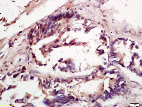 Formalin-fixed and paraffin embedded human gastric cancer labeled with Anti phospho-c-Raf(Tyr341) Polyclonal Antibody, Unconjugated (bs-5650R) at 1:200 followed by conjugation to the secondary antibody and DAB staining