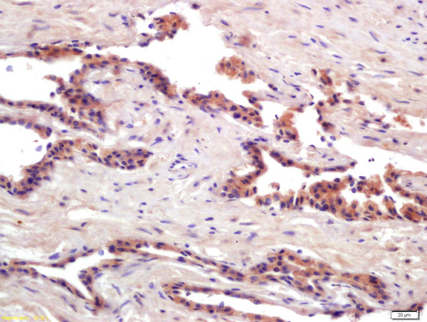 Formalin-fixed and paraffin embedded human prostate cancer labeled with Anti-PRSS8 Polyclonal Antibody, Unconjugated (bs-6064R) at 1:200 followed by conjugation to the secondary antibody and DAB staining