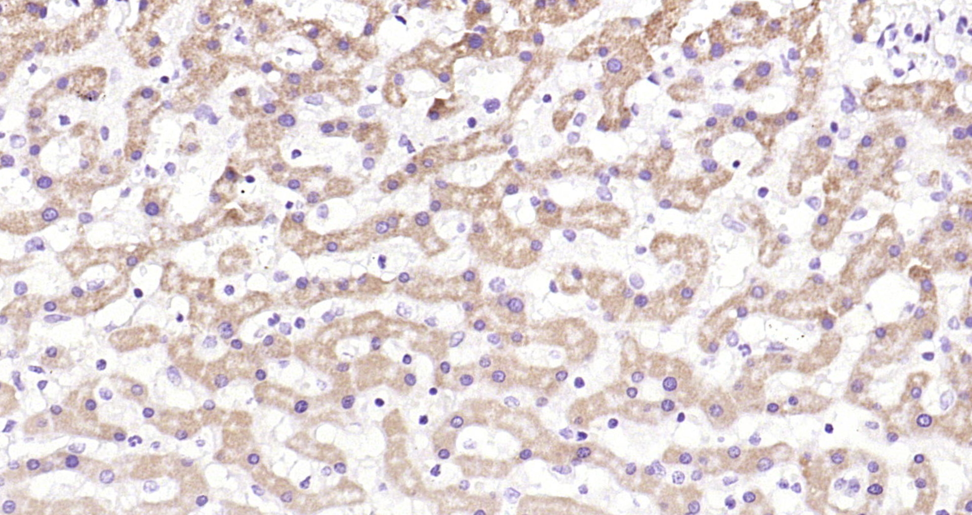 Paraformaldehyde-fixed, paraffin embedded (human liver); Antigen retrieval by boiling in sodium citrate buffer (pH6.0) for 15min; Block endogenous peroxidase by 3% hydrogen peroxide for 20 minutes; Blocking buffer (normal goat serum) at 37°C for 30min; Antibody incubation with (IGF2R) Polyclonal Antibody, Unconjugated (bs-6670R) at 1:200 overnight at 4°C, followed by operating according to SP Kit(Rabbit) (sp-0023) instructionsand DAB staining.