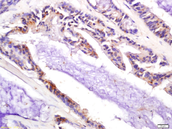 Formalin-fixed and paraffin embedded human colon carcinoma labeled with Anti-P21 Polyclonal Antibody, Unconjugated (bs-10129R) at 1:200 followed by conjugation to the secondary antibody and DAB staining Formalin-fixed and paraffin embedded human colon carcinoma labeled with Anti-P21 Polyclonal Antibody, Unconjugated (bs-10129R) at 1:200 followed by conjugation to the secondary antibody and DAB staining