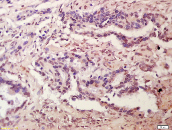 Formalin-fixed and paraffin embedded human colon carcinoma labeled with Anti-Plakophilin 2 Polyclonal Antibody, Unconjugated (bs-11063R) at 1:200 followed by conjugation to the secondary antibody and DAB staining