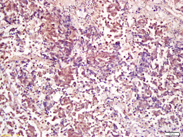 Formalin-fixed and paraffin embedded human lung carcinoma labeled with Anti-PP2A alpha + beta Polyclonal Antibody, Unconjugated (bs-0029R) at 1:200 followed by conjugation to the secondary antibody and DAB staining