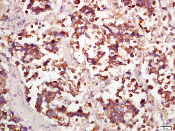 Formalin-fixed and paraffin embedded human lung carcinoma labeled with Anti-PPP4C Polyclonal Antibody, Unconjugated (bs-0490R) at 1:200 followed by conjugation to the secondary antibody and DAB staining\n