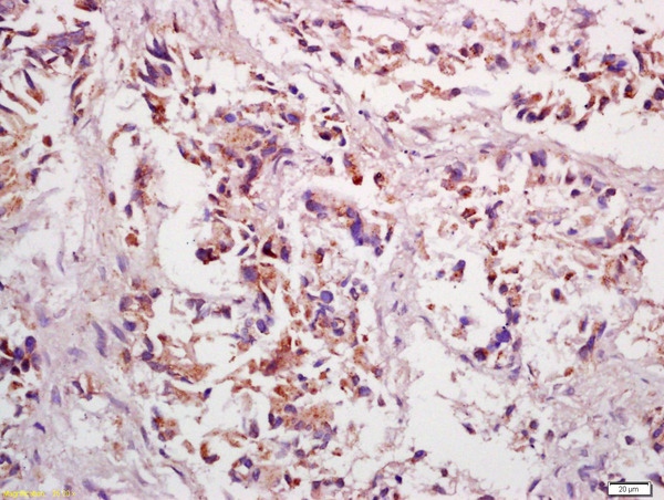 Formalin-fixed and paraffin embedded human gastric cancer labeled with Anti-PPP4C Polyclonal Antibody, Unconjugated (bs-0490R) at 1:200 followed by conjugation to the secondary antibody and DAB staining