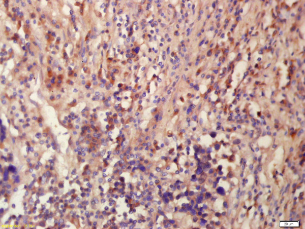 Formalin-fixed and paraffin embedded human lung carcinoma labeled with Anti-Tubulin-Beta Polyclonal Antibody, Unconjugated (bs-0715R) at 1:200 followed by conjugation to the secondary antibody and DAB staining