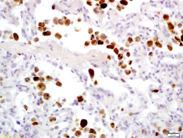 Formalin-fixed and paraffin embedded human lung carcinoma labeled with Anti-Granzyme B Polyclonal Antibody, Unconjugated (bs-1351R) at 1:200 followed by conjugation to the secondary antibody and DAB staining