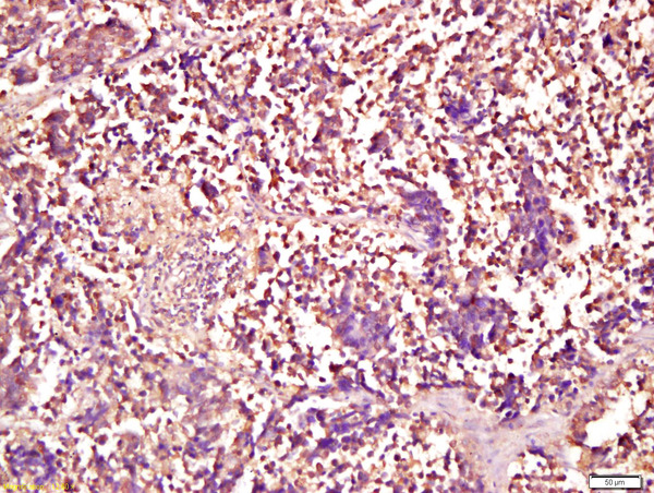 Formalin-fixed and paraffin embedded human lung carcinoma labeled with Anti-Smad1 Polyclonal Antibody, Unconjugated (bs-1619R) at 1:200 followed by conjugation to the secondary antibody and DAB staining\n