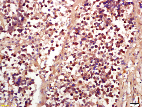 Formalin-fixed and paraffin embedded human lung carcinoma labeled with Anti-Phospho-RSK2 (Ser227) Polyclonal Antibody, Unconjugated (bs-3367R) at 1:200 followed by conjugation to the secondary antibody and DAB staining