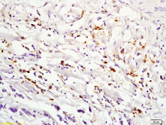 Formalin-fixed and paraffin embedded human lung carcinoma labeled with Anti-IL2RA Polyclonal Antibody, Unconjugated (bs-0577R) at 1:200 followed by conjugation to the secondary antibody and DAB staining