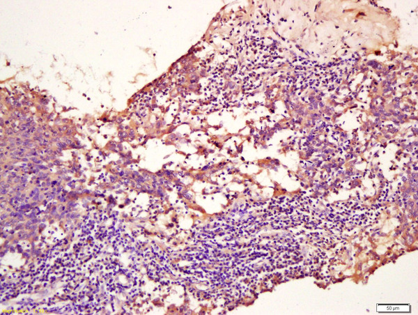 Formalin-fixed and paraffin-embedded human breast carcinoma labeled with TPM2 Polyclonal Antibody, Unconjugated (bs-1243R) at 1:200 followed by incubation with secondary antibody and DAB staining