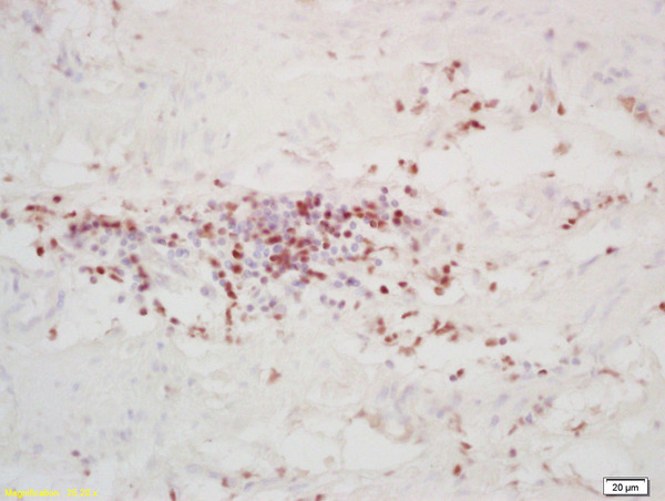 Formalin-fixed and paraffin embedded human colon carcinoma labeled with Rabbit Anti FOXD3 Polyclonal Antibody, Unconjugated (bs-11518R) at 1:200 followed by conjugation to the secondary antibody and DAB staining