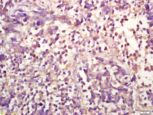 Formalin-fixed and paraffin embedded human lung carcinoma labeled with Anti-phospho-ERK1(Thr202/Tyr204)+ERK2(Thr183/Tyr185) Polyclonal Antibody, Unconjugated (bs-1646R) at 1:200 followed by conjugation to the secondary antibody and DAB staining