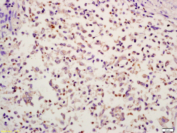 Formalin-fixed and paraffin embedded human colon carcinoma labeled with Anti-HMGB4 Polyclonal Antibody, Unconjugated (bs-1820R) at 1:200 followed by conjugation to the secondary antibody and DAB stainin