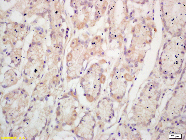 Formalin-fixed and paraffin embedded human gastric cancer labeled with Anti-TFF2 Polyclonal Antibody, Unconjugated (bs-1921R) at 1:200 followed by conjugation to the secondary antibody and DAB staining
