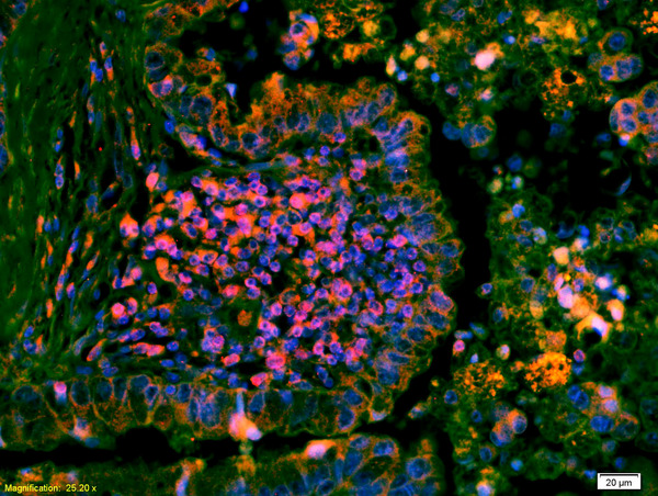 Formalin-fixed and paraffin embedded human lung carcinoma labeled with Anti-phospho-ERK1/2(Thr202 + Tyr204)Polyclonal Antibody, Unconjugated (bs-3016R) at 1:200 followed by conjugation to the secondary antibody Goat Anti-Rabbit IgG, Cy3 conjugated(bs-0295G-Cy3) used at 1:200 dilution for 40 minutes at 37°C and DAPI staining
