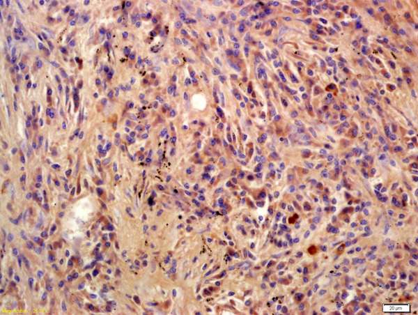 Formalin-fixed and paraffin embedded human lung carcinoma labeled with Anti-Phospho-BLNK(Tyr96)Polyclonal Antibody, Unconjugated (bs-3054R) at 1:200 followed by conjugation to the secondary antibody and DAB staining