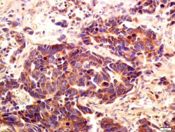 Formalin-fixed and paraffin embedded human lung carcinoma labeled with Anti-PI 3 Kinase Class 3 Polyclonal Antibody, Unconjugated (bs-4159R) at 1:200 followed by conjugation to the secondary antibody and DAB staining