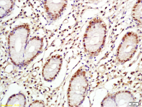 Formalin-fixed and paraffin embedded human gastric cancer labeled with Anti-C-Myc Polyclonal Antibody, Unconjugated (bs-4963R) at 1:200 followed by conjugation to the secondary antibody and DAB staining\\n