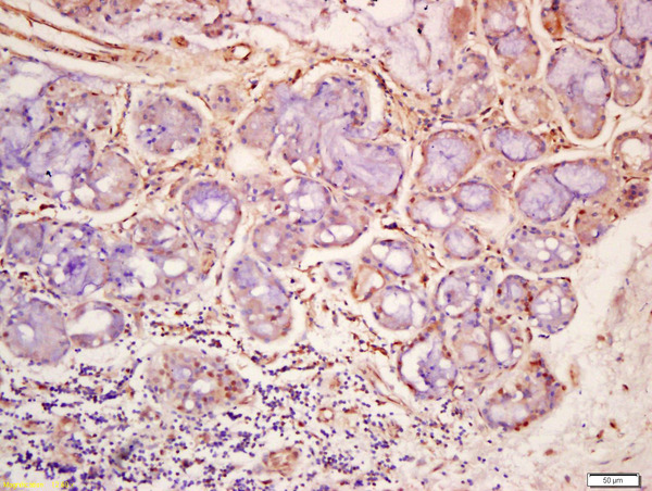 Formalin-fixed and paraffin embedded human lung carcinoma labeled with Anti-phospho-ERK5 (Ser496) Polyclonal Antibody, Unconjugated (bs-5484R) at 1:200 followed by conjugation to the secondary antibody and DAB staining