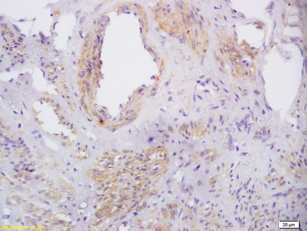 Formalin-fixed and paraffin embedded human cervical carcinoma labeled with Rabbit Anti phospho-CXCR4(Ser339) Polyclonal Antibody, Unconjugated (bs-12256R) at 1:200 followed by conjugation to the secondary antibody and DAB staining