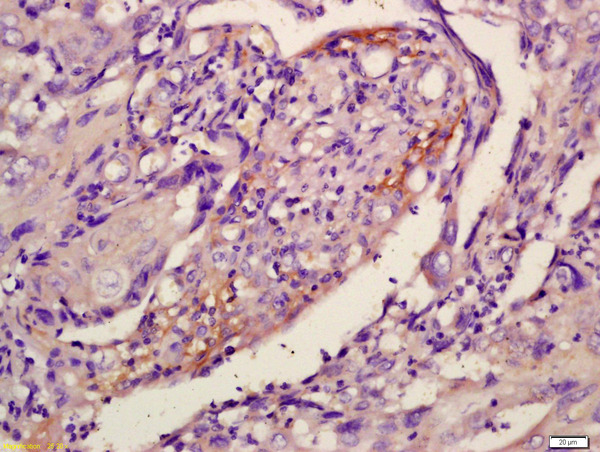Formalin-fixed and paraffin embedded human laryngocarcinoma labeled with Anti-Dyrk1B Polyclonal Antibody, Unconjugated (bs-6259R) at 1:200 followed by conjugation to the secondary antibody and DAB staining\n
