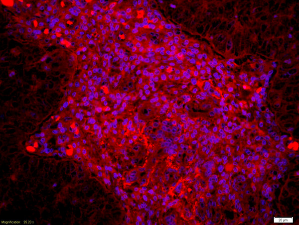 Formalin-fixed and paraffin embedded human laryngocarcinoma labeled with Anti Dyrk1B Polyclonal Antibody, Unconjugated (bs-6259R) at 1:200 followed by conjugation to the secondary antibody Goat Anti-Rabbit IgG, Cy3 conjugated(bs-0295G-Cy3) used at 1:200 dilution for 40 minutes at 37°C and DAPI staining