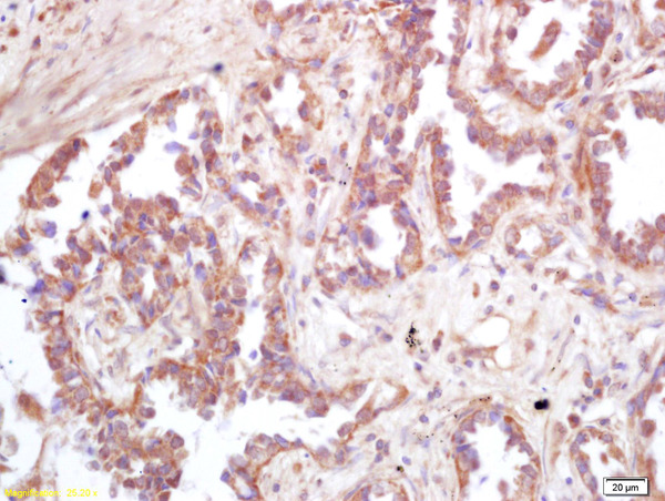 Formalin-fixed and paraffin embedded human lung carcinoma labeled with Rabbit Anti ATP6IP2 Polyclonal Antibody, Unconjugated (bs-7691R) at 1:200 followed by conjugation to the secondary antibody and DAB staining