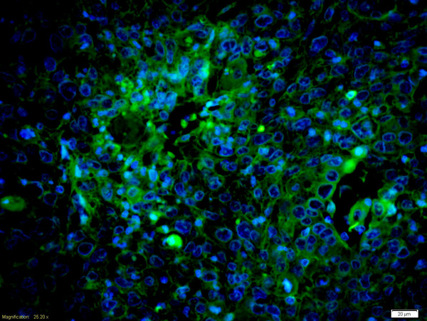 Formalin-fixed and paraffin embedded human laryngocarcinoma labeled with Anti-caspase-8 subunit p18 Polyclonal Antibody, Unconjugated (bs-6463R) at 1:200 followed by conjugation to the secondary antibody Goat Anti-Rabbit IgG, AF488 conjugated(bs-0295G-A488) used at 1:200 dilution for 40 minutes at 37°C and DAPI staining