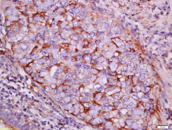 Formalin-fixed and paraffin embedded human lung carcinoma labeled with Rabbit Anti-pan-Cytokeratin Polyclonal Antibody, Unconjugated (bs-2190R) at 1:200 followed by conjugation to the secondary antibody and DAB staining