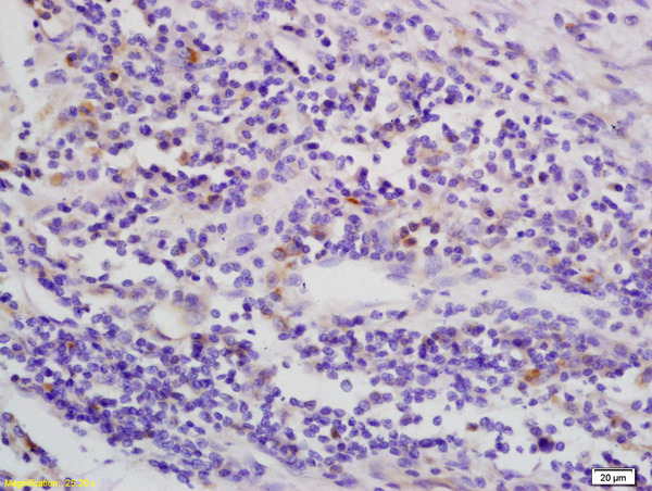 Formalin-fixed and paraffin embedded human esophagus carcinoma labeled with Anti-phospho-LKB1 (Thr363)Polyclonal Antibody, Unconjugated (bs-1532R) at 1:200 followed by conjugation to the secondary antibody and DAB staining