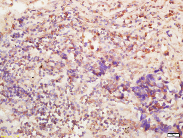 Formalin-fixed and paraffin embedded human lung carcinoma labeled with Anti-BTBD7 Polyclonal Antibody, Unconjugated (bs-7979R) at 1:200 followed by conjugation to the secondary antibody and DAB staining