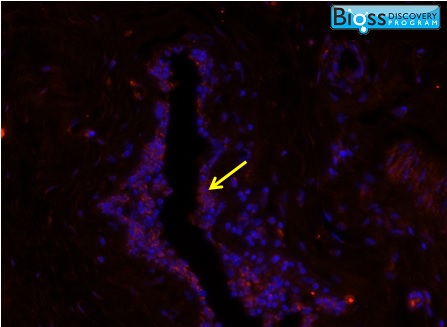 Image was kindly submitted by Erica Pimenta from UMDNJ. Human breast tumor tissue stained with Rabbit Anti-CXCL13 Polyclonal Antibody (bs-2553R)